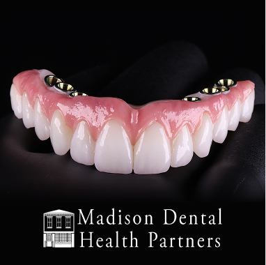 Hybrid Implant Bridge